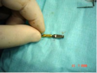 /album/galeria-de-fotos-carga-imediata-apos-exodontia-atraumatica-/carga-imediata-com-exodontia-atraumatica8-jpg/